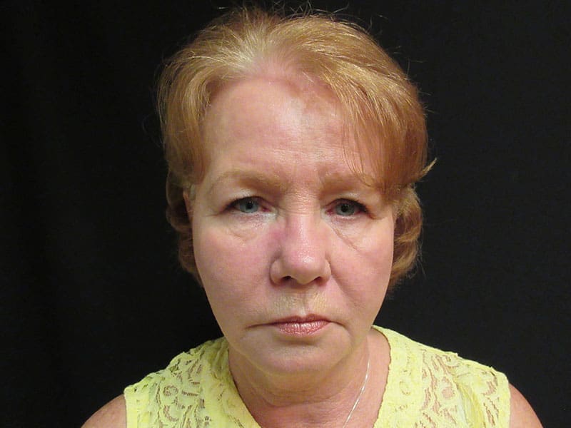 Facelift before and after - before