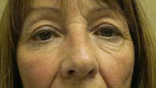 Upper and Lower Blepharoplasty before and after - before