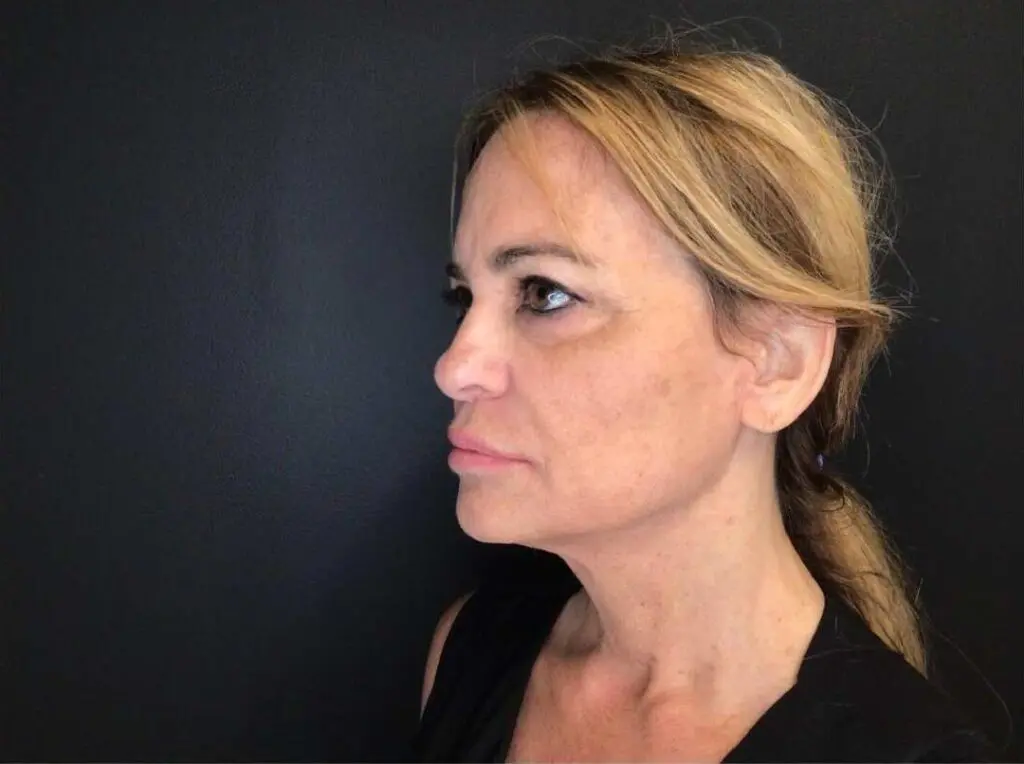 Facelift before and after - before