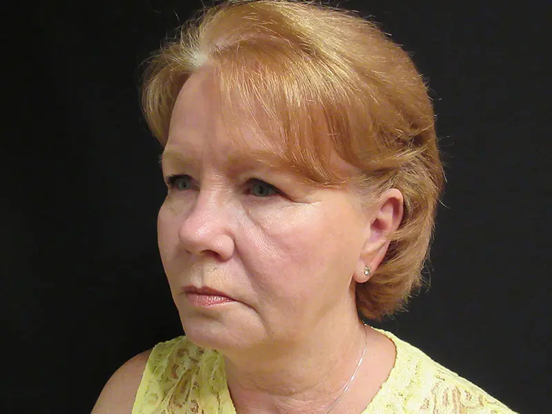 Facelift before and after - before