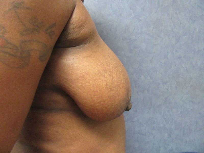 Breast Reduction before and after - before