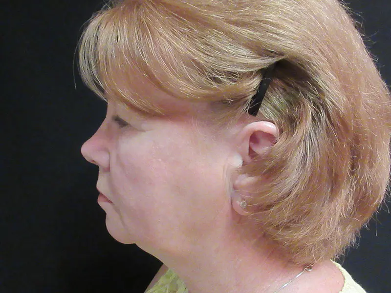 Facelift before and after - before