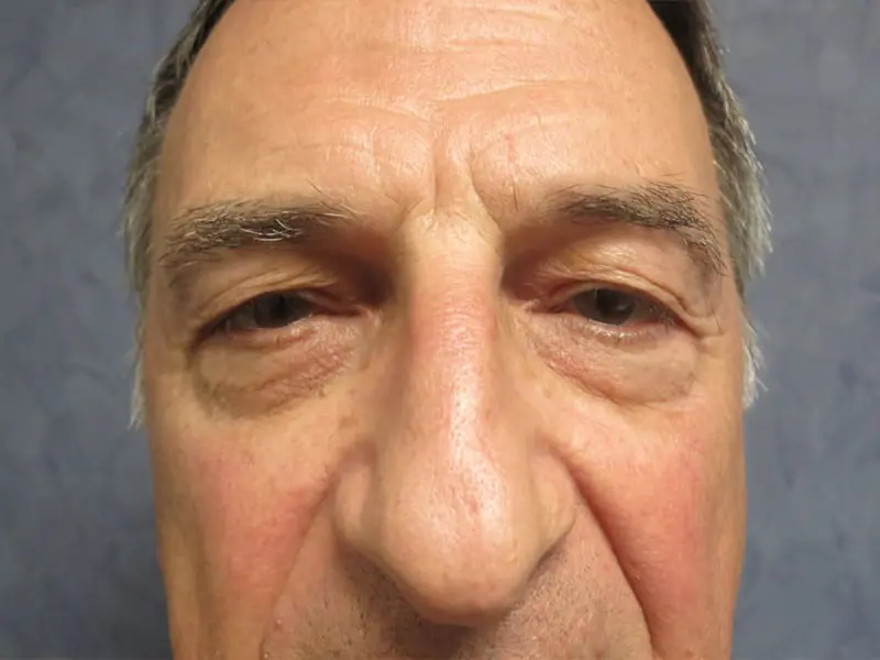 Upper and Lower Blepharoplasty before and after - before