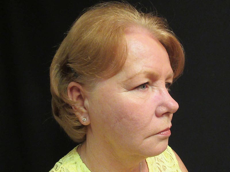Facelift before and after - before