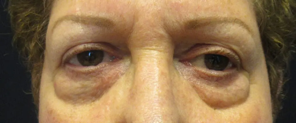 Upper and Lower Blepharoplasty before and after - before