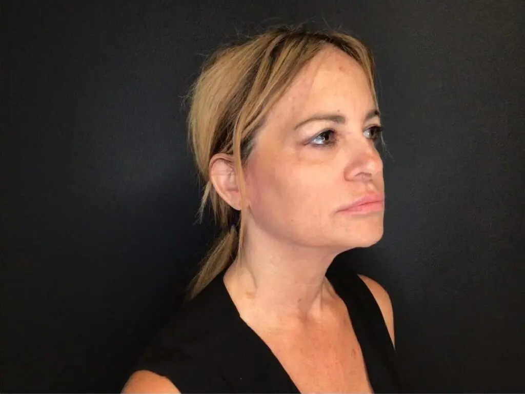 Facelift before and after - before