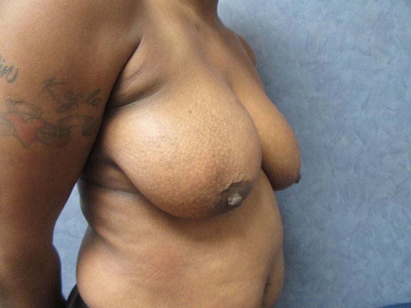 Breast Reduction before and after - before