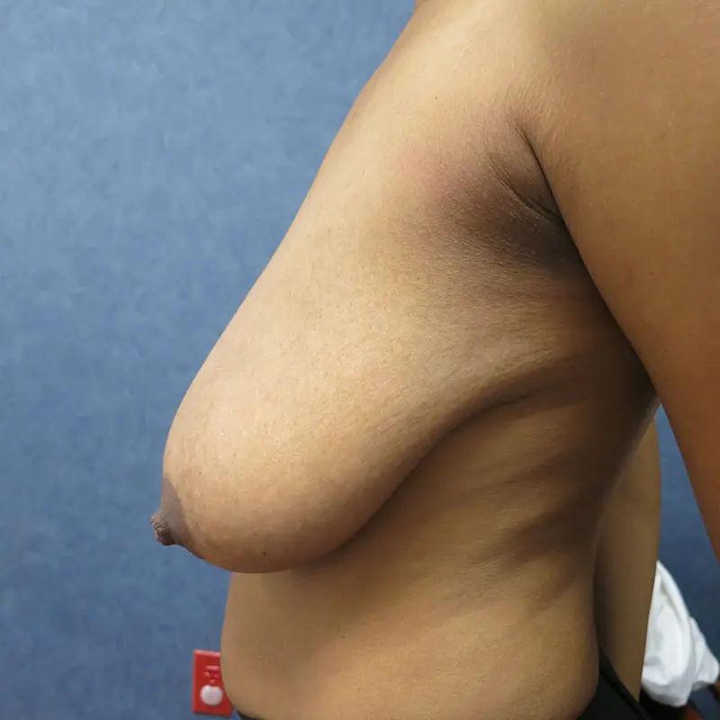 Breast Reduction before and after - before