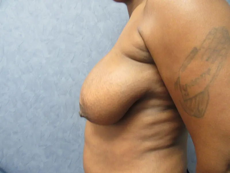 Breast Reduction before and after - before