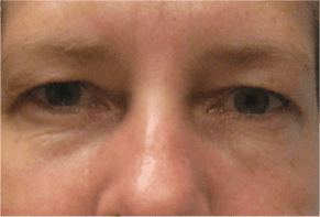Blepharoplasty before and after - before