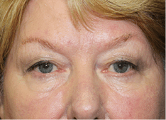 Blepharoplasty before and after - before