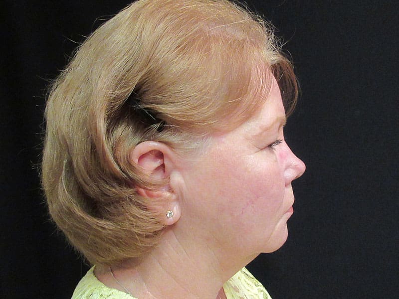 Facelift before and after - before