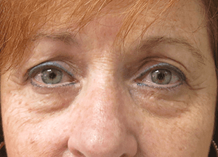 Blepharoplasty before and after - before