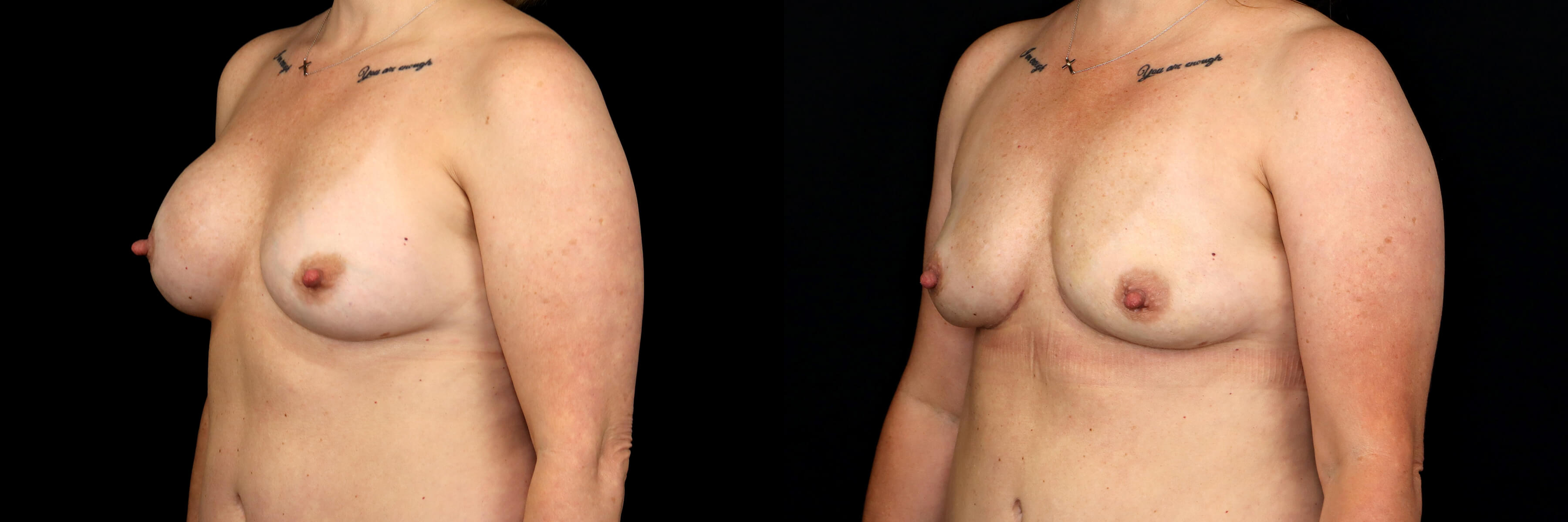 Breast Implant Removal before and after - after