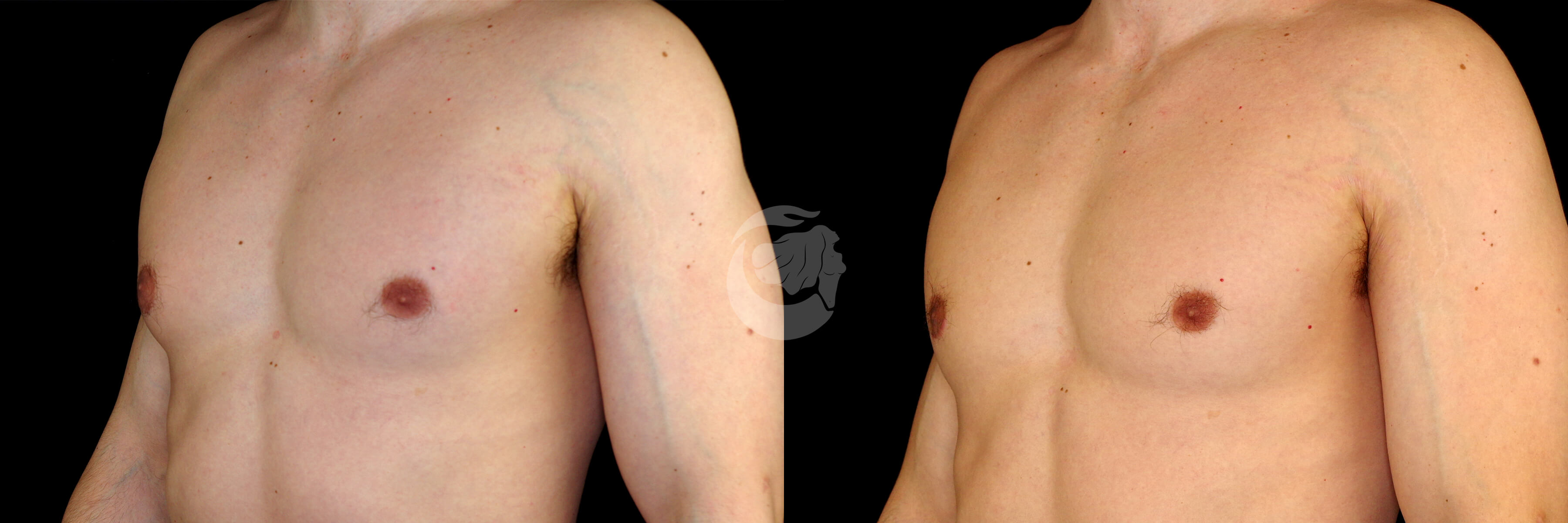 Gynecomastia before and after - after