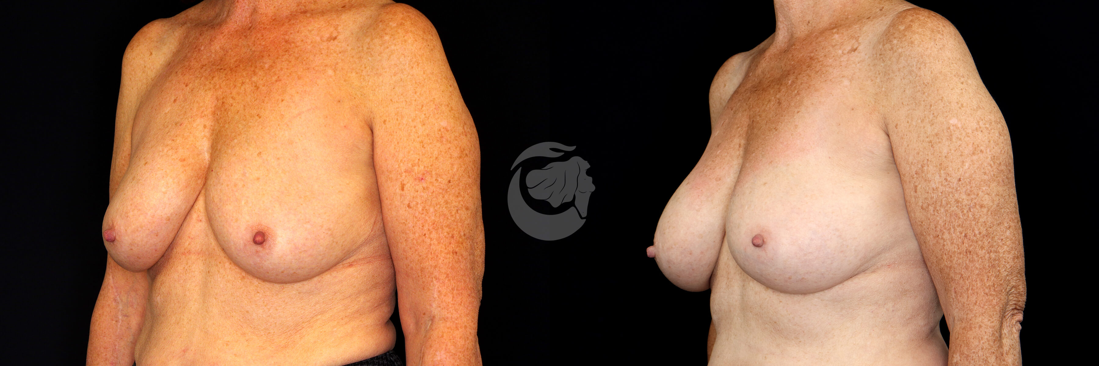 Breast Augmentation before and after - after