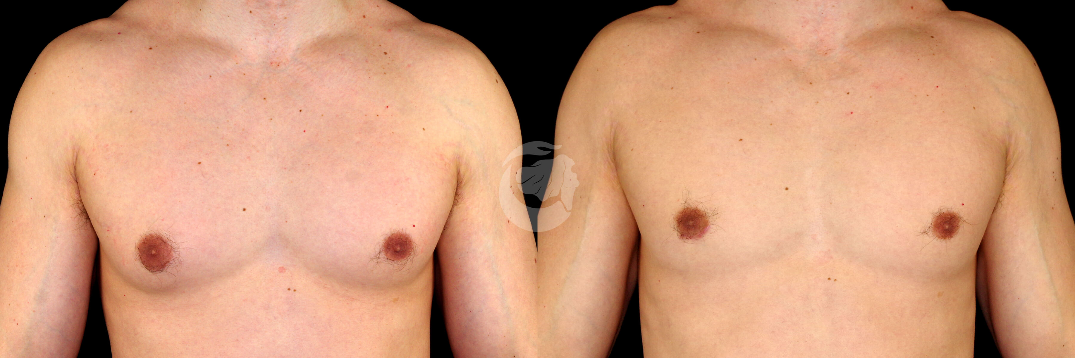 Gynecomastia before and after - before