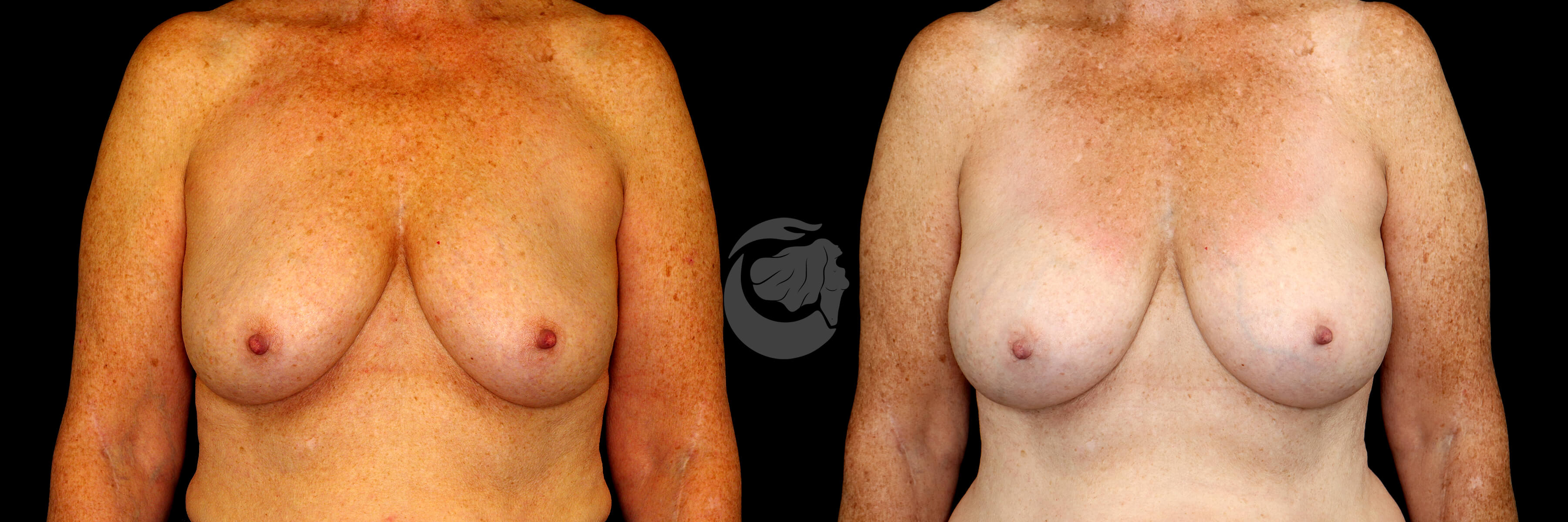 Breast Augmentation before and after - before