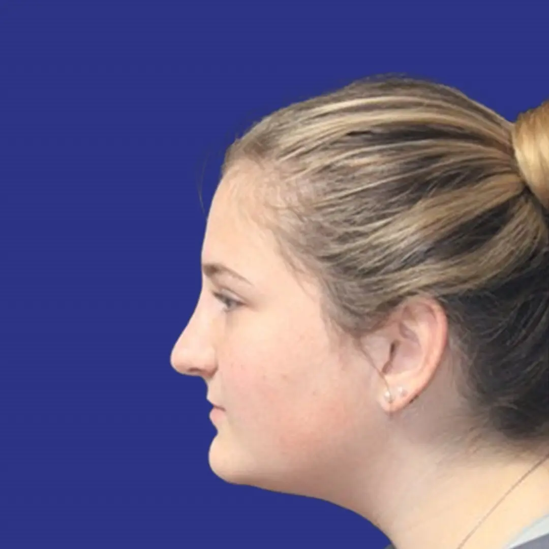 Procedure before and after - after