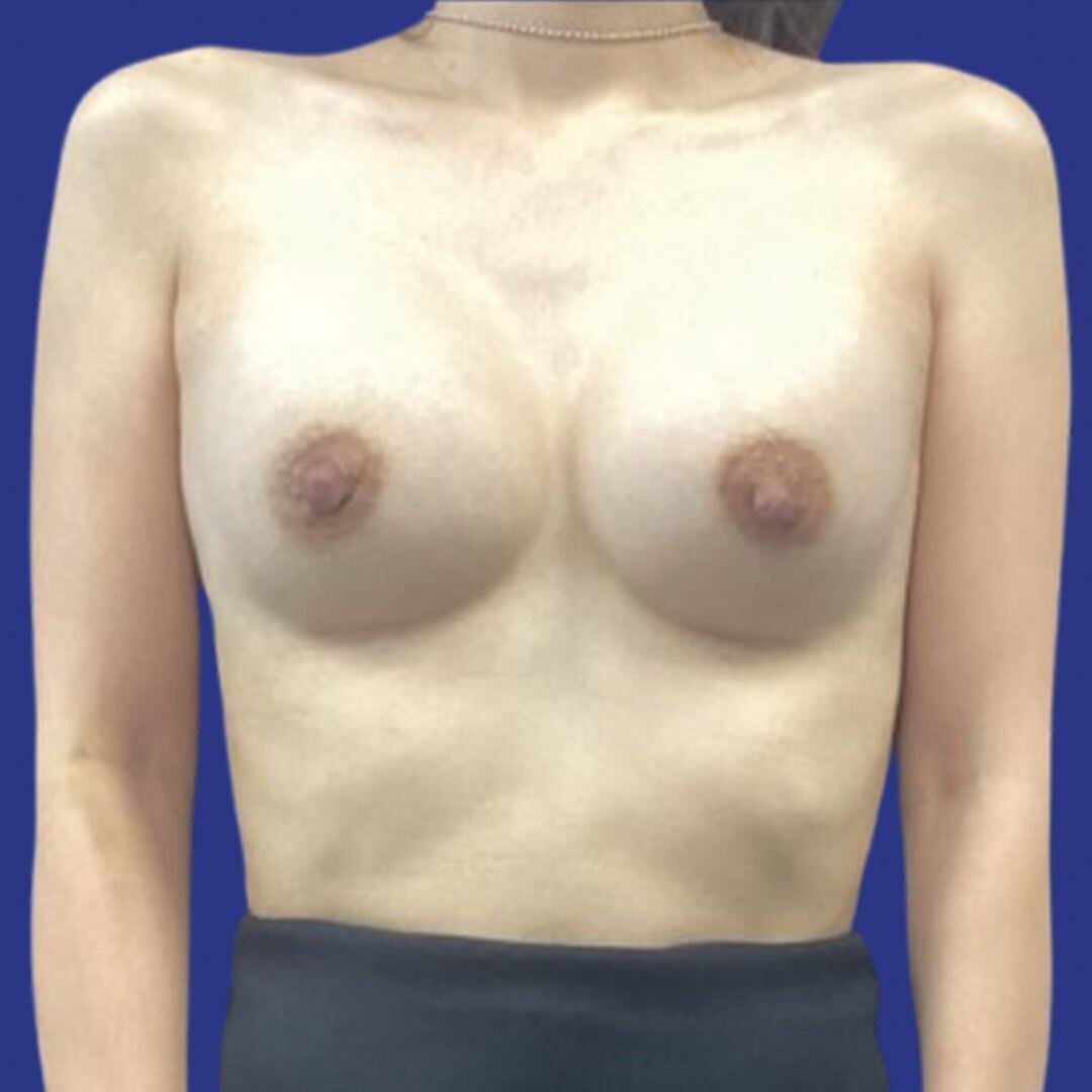 Procedure before and after - after