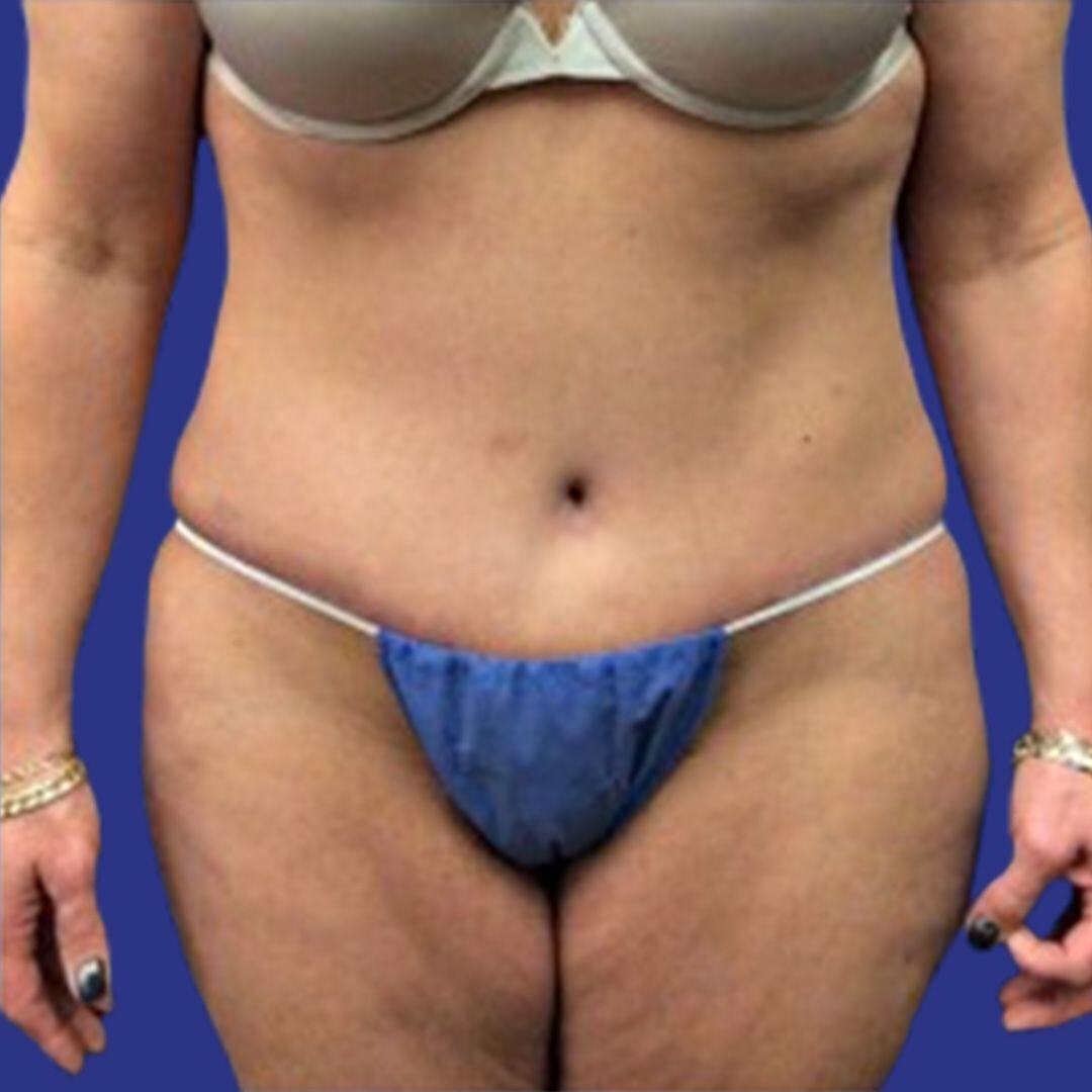 Procedure before and after - after