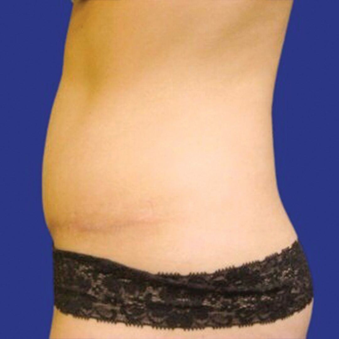 Procedure before and after - after