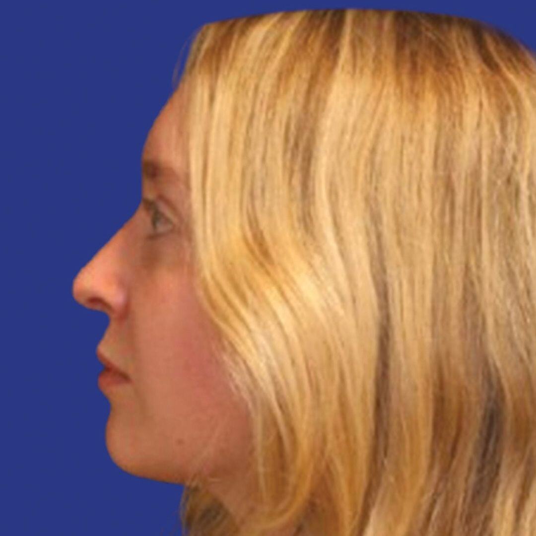 Procedure before and after - after