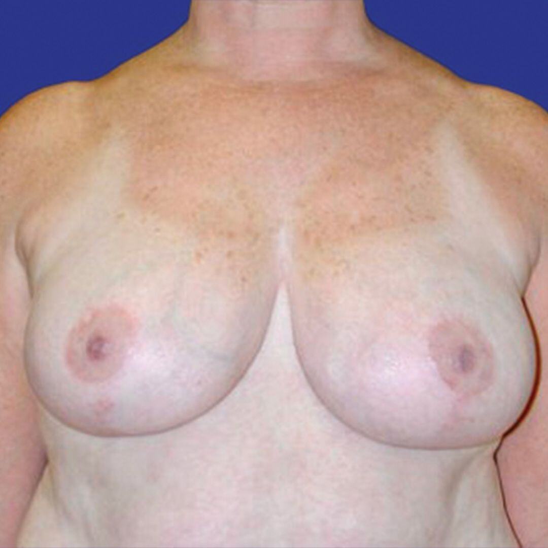 Procedure before and after - after