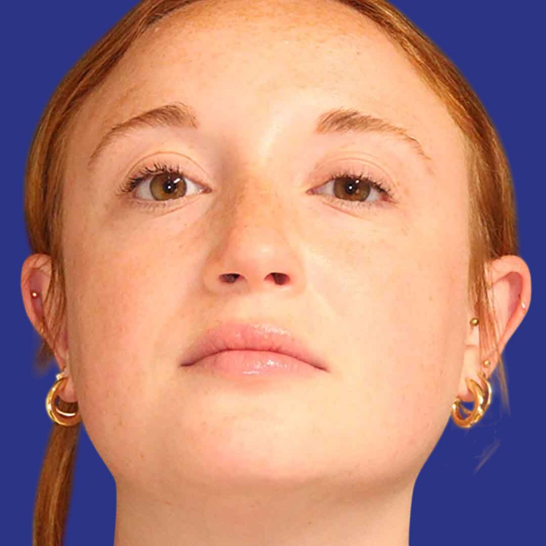 Procedure before and after - after