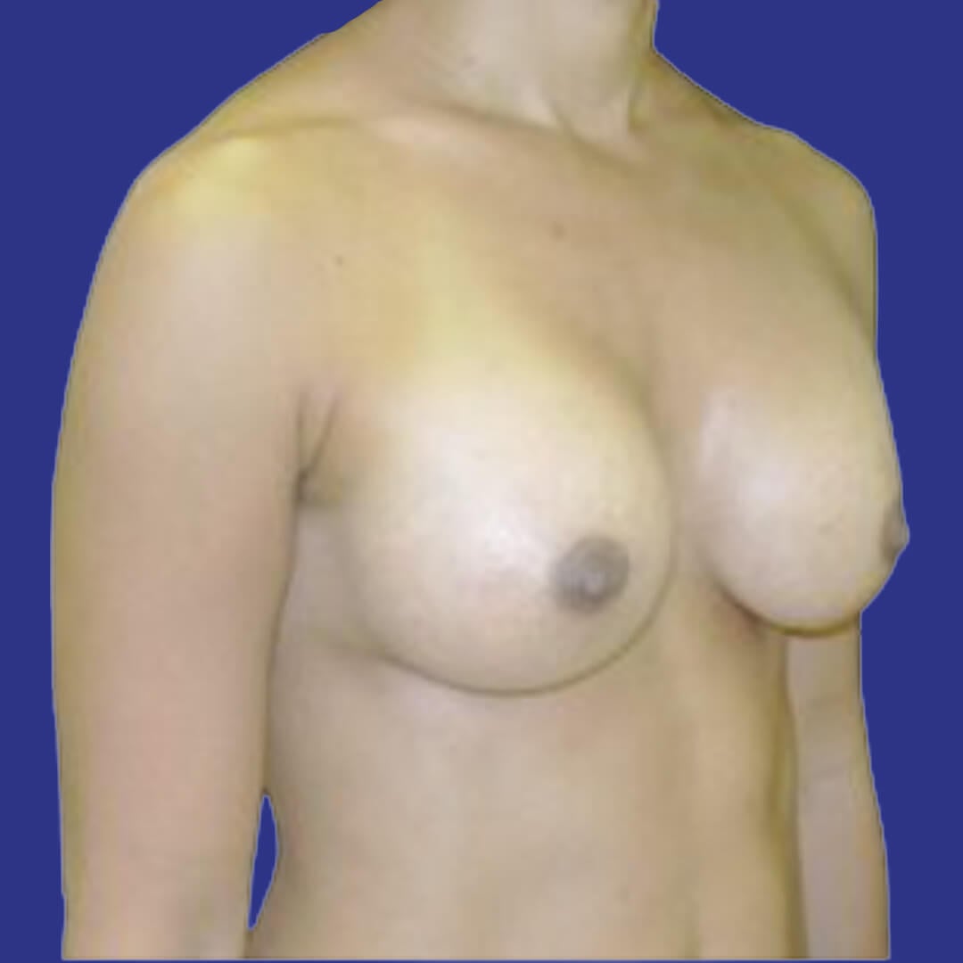 Procedure before and after - after