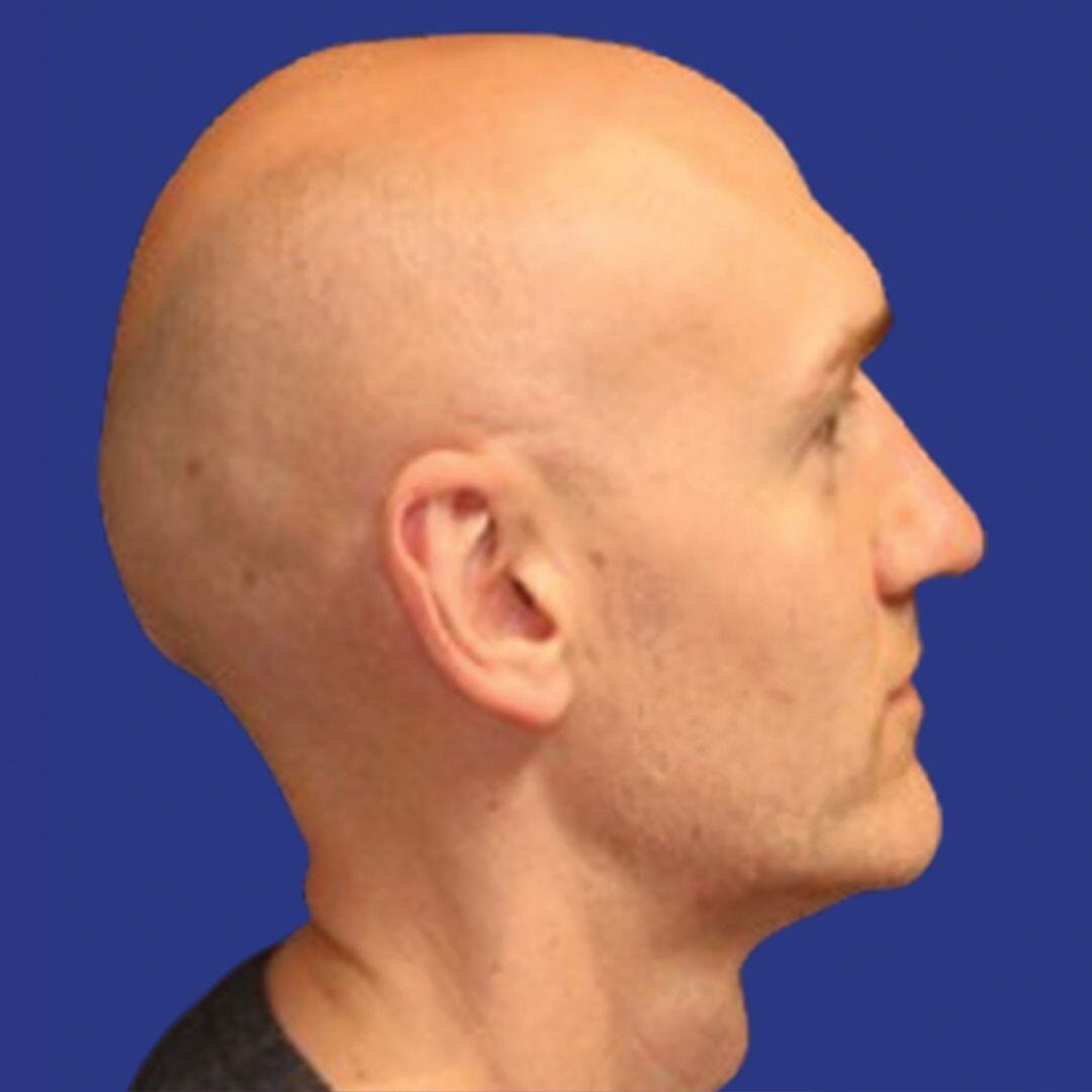 Procedure before and after - after