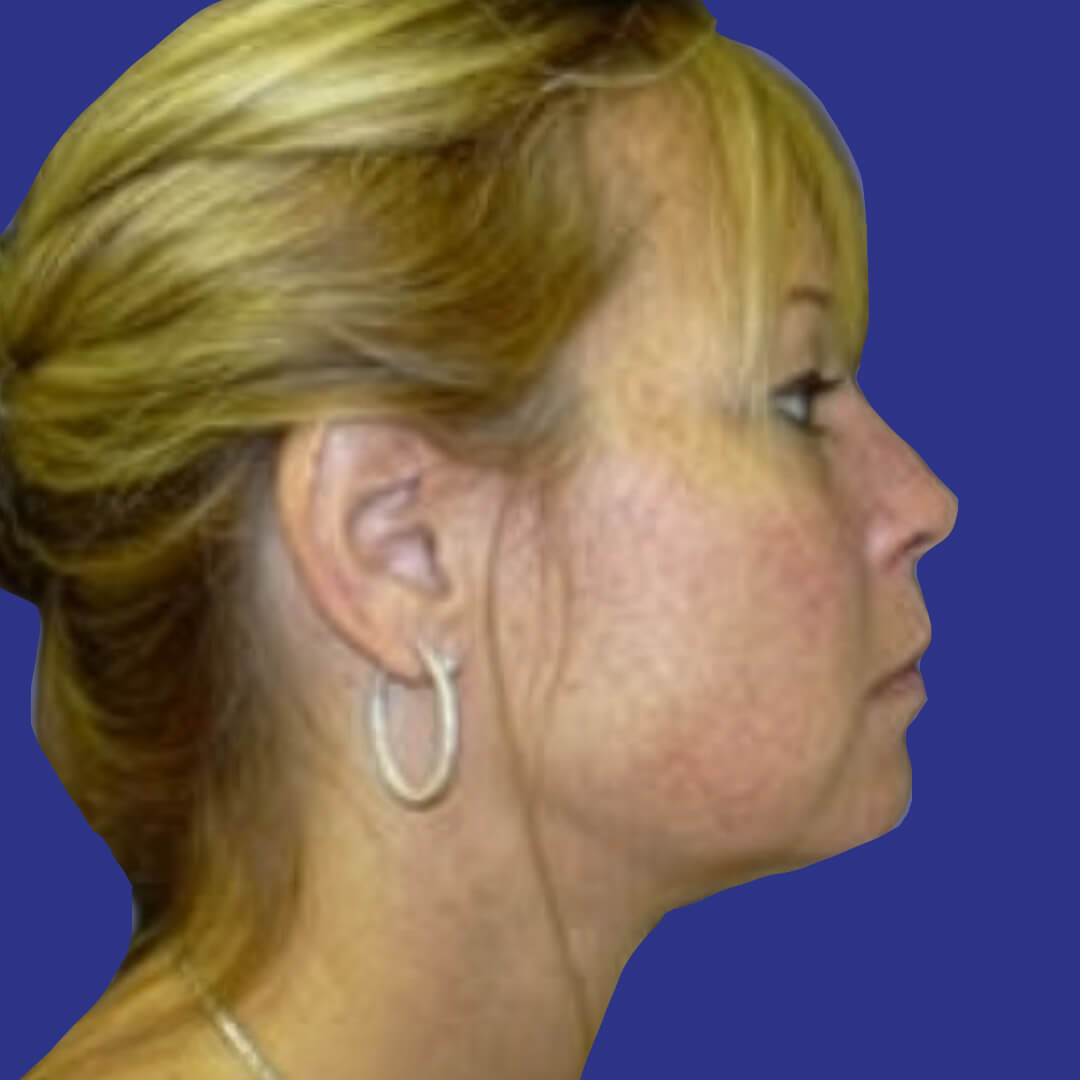 Procedure before and after - after