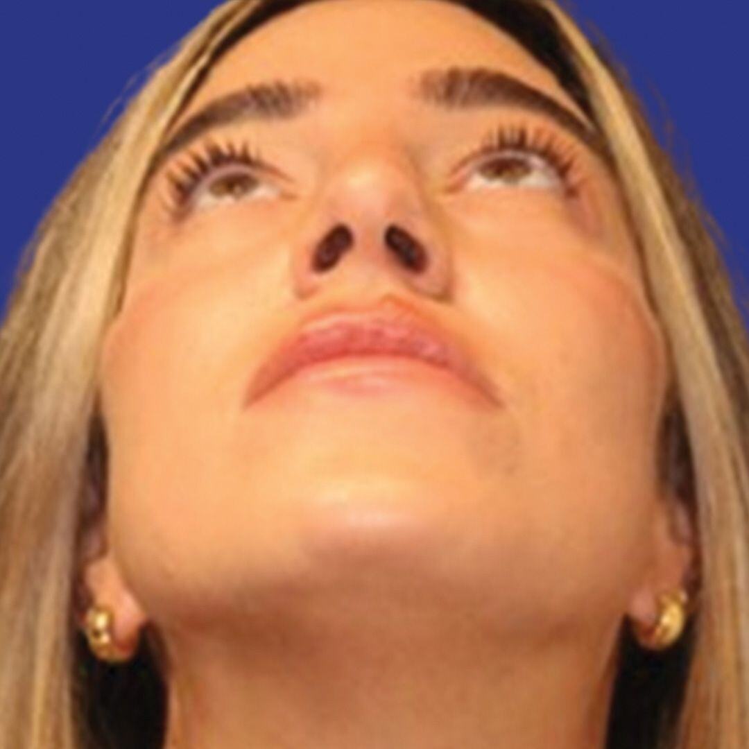 Procedure before and after - after