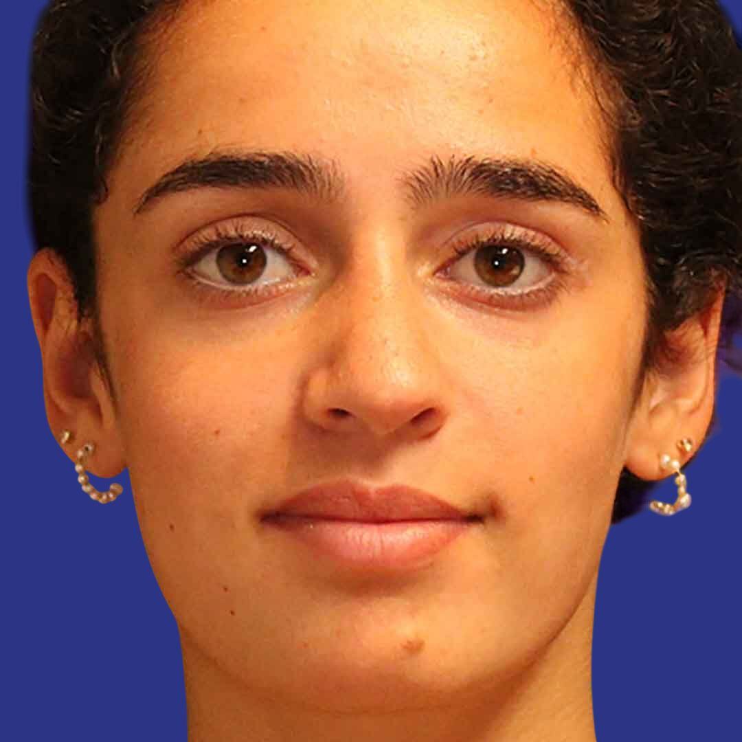 Procedure before and after - after