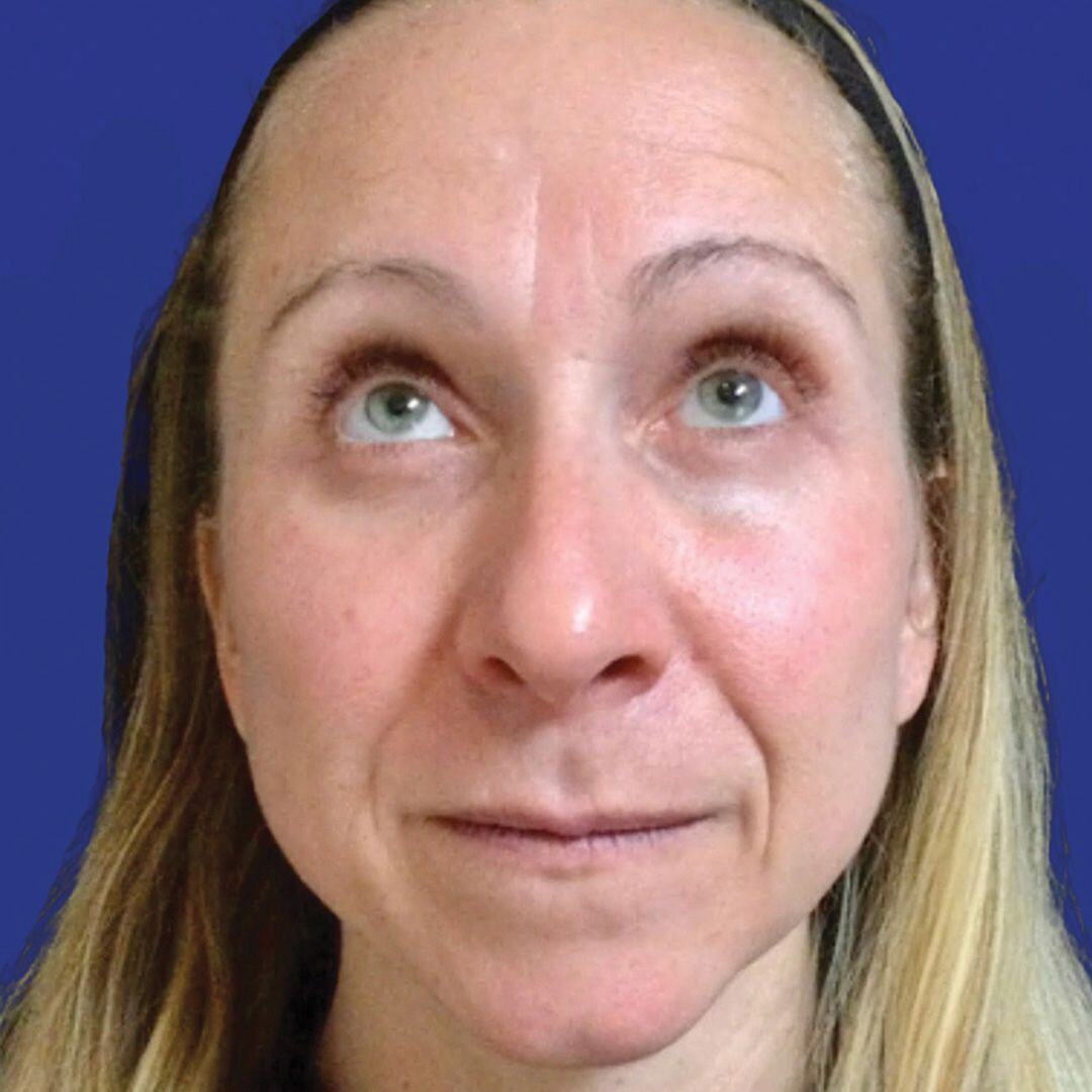 Procedure before and after - after