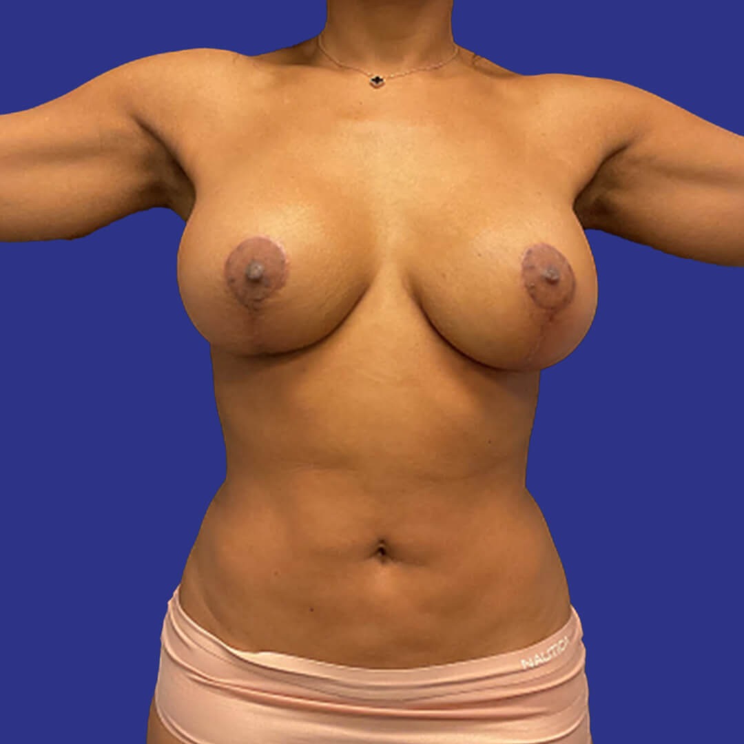 Procedure before and after - after