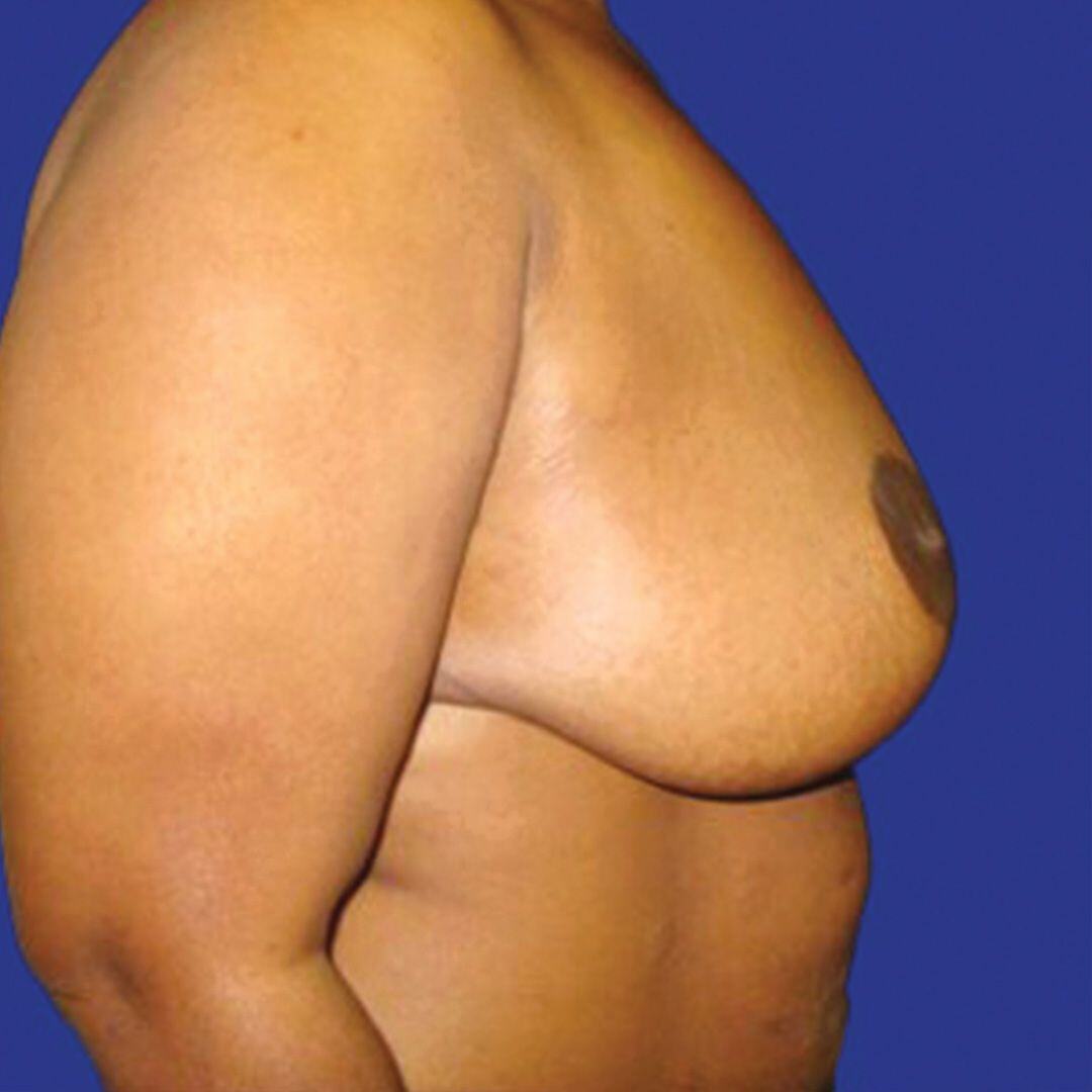 Procedure before and after - after