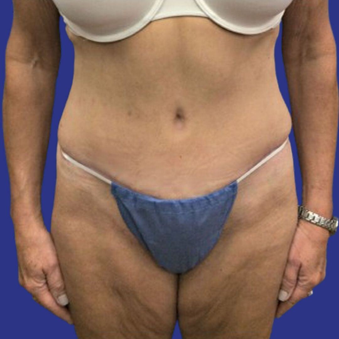 Procedure before and after - after