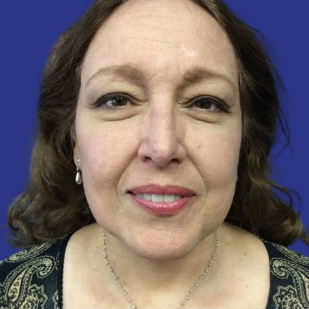 Procedure before and after - after