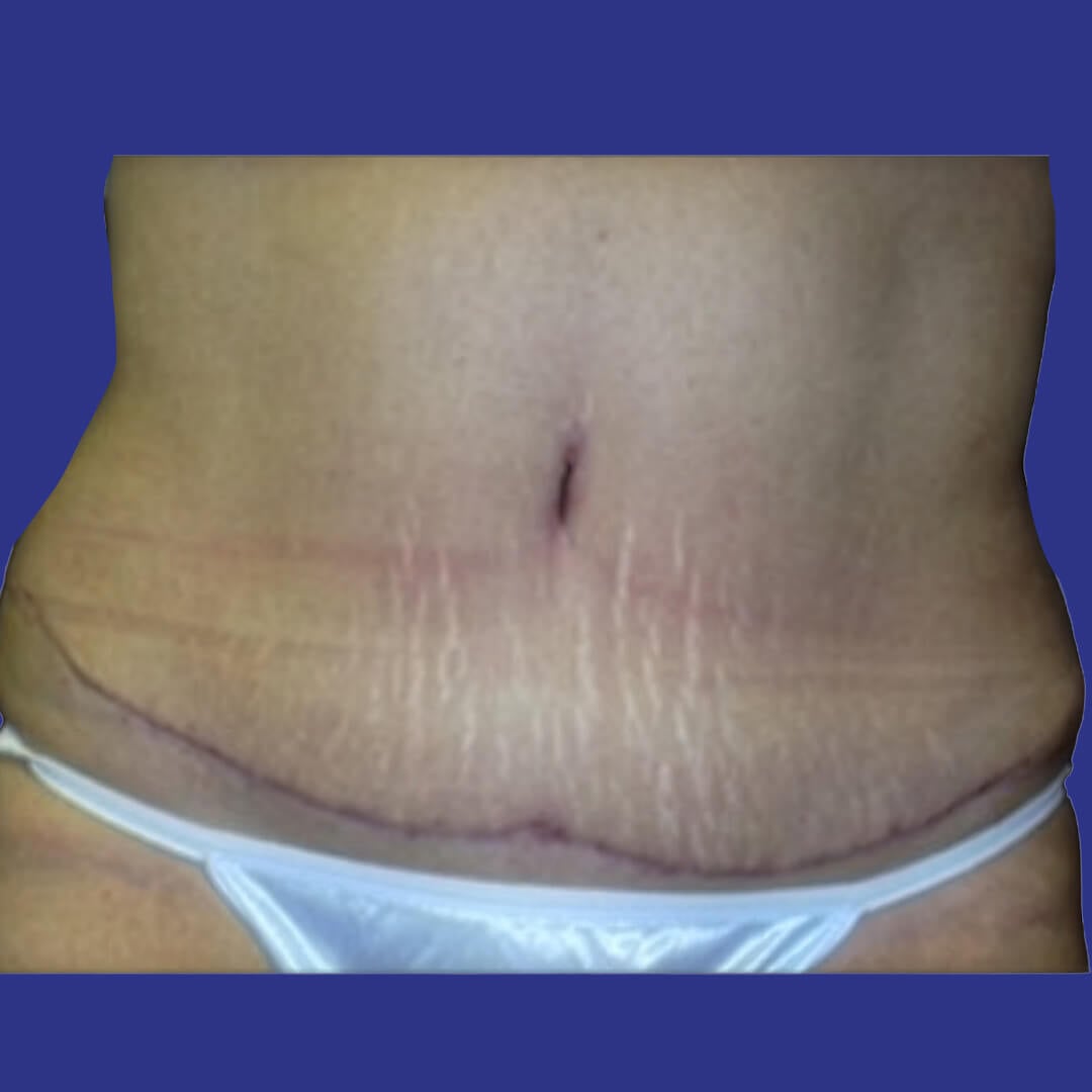 Procedure before and after - after