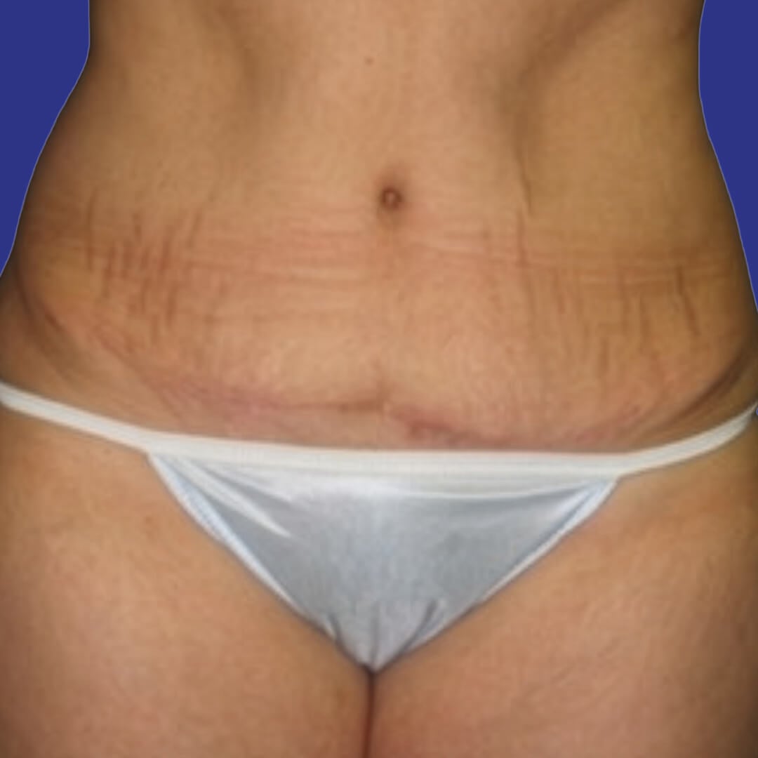 Procedure before and after - after