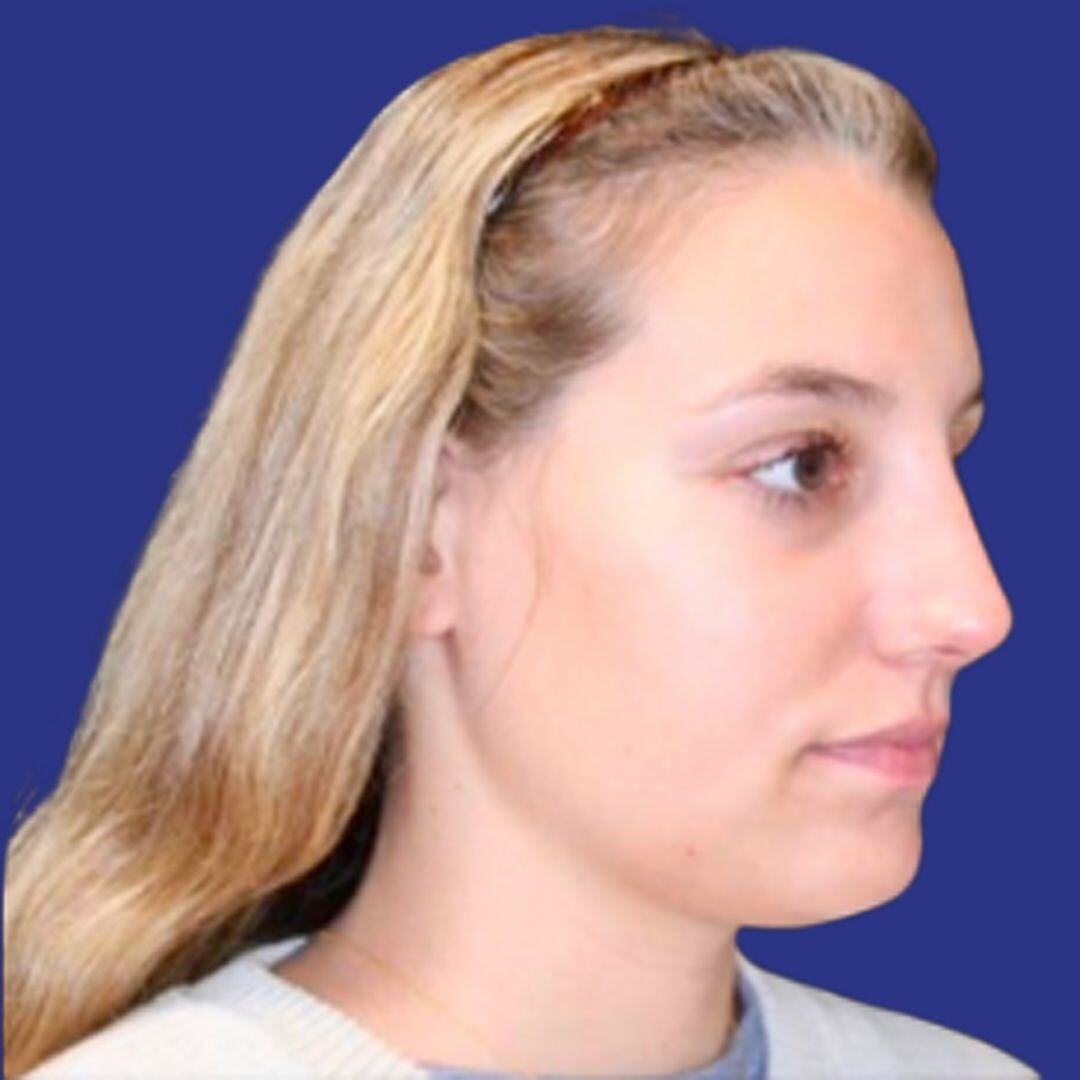 Procedure before and after - after