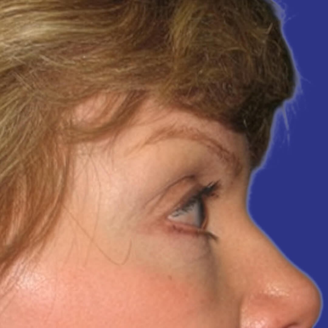 Procedure before and after - after