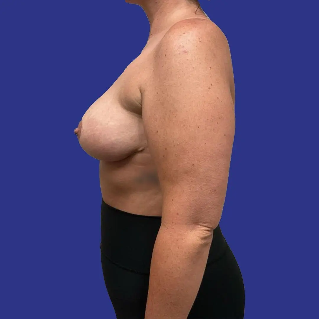 Procedure before and after - after