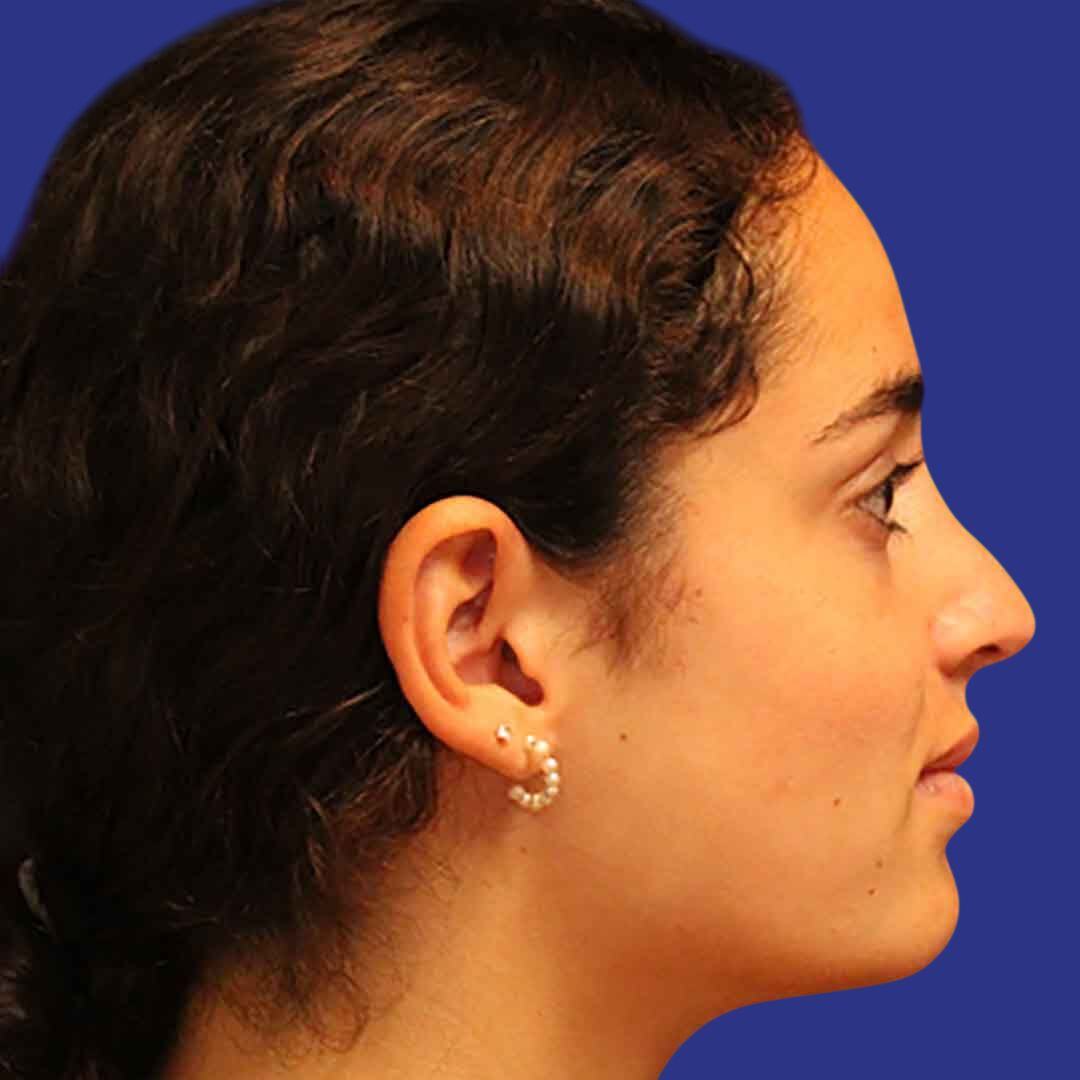 Procedure before and after - after