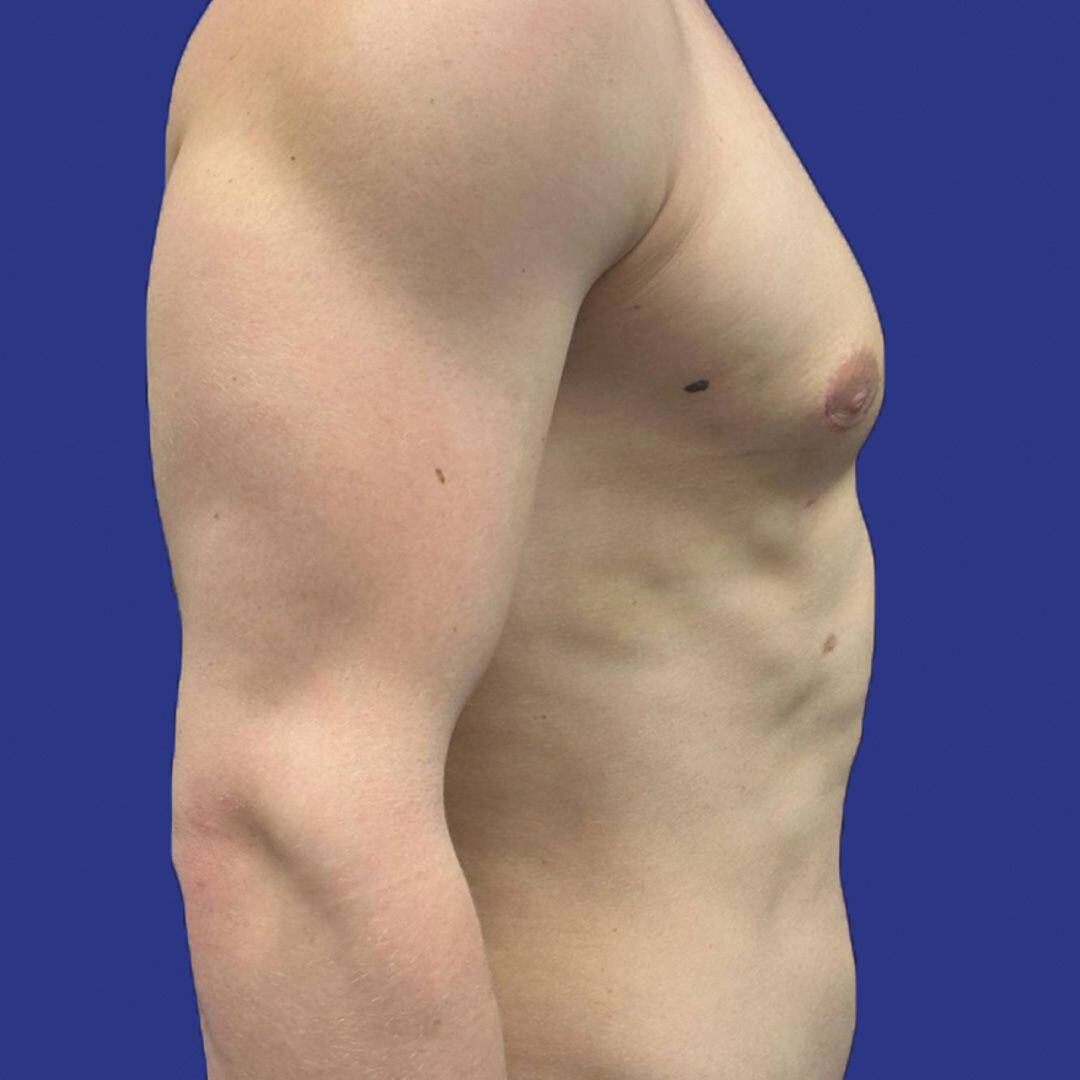 Procedure before and after - after