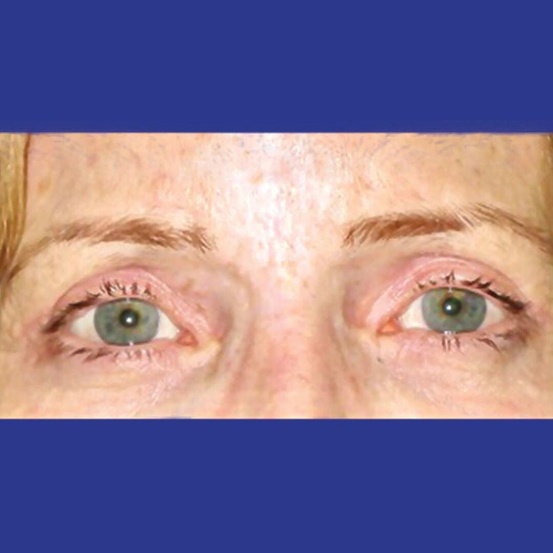 Procedure before and after - after
