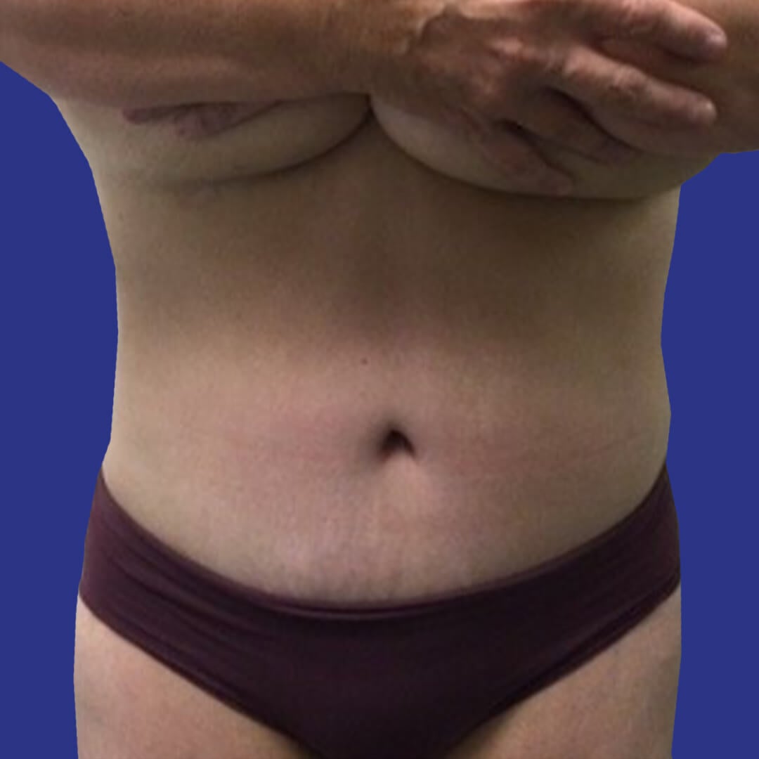 Procedure before and after - after