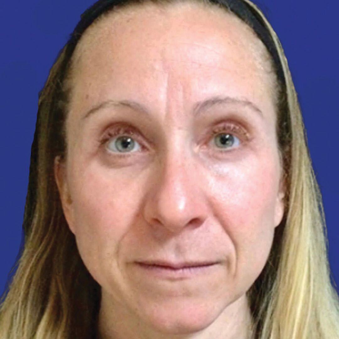 Procedure before and after - after