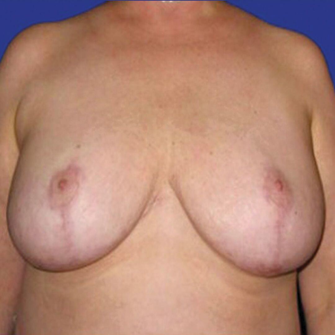 Procedure before and after - after